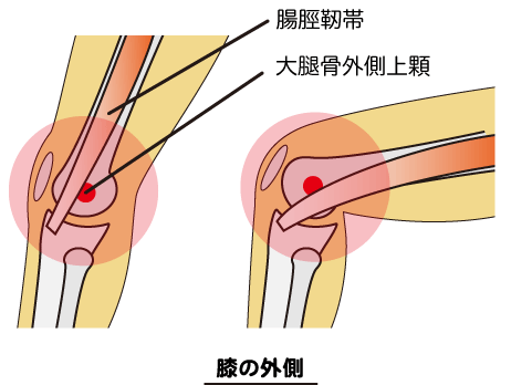 腸脛靭帯炎・ランナー膝で痛みの出る箇所を説明した画像