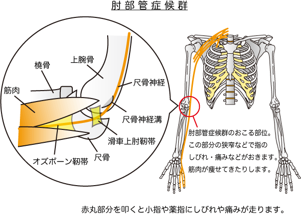 肘部管症候群の原因を表す画像