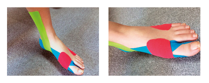 扁平足や外反母趾、足の裏アーチをつけるためのテーピングの画像