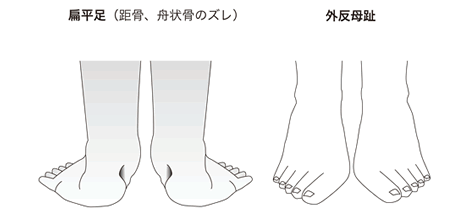扁平足や外反母趾の説明