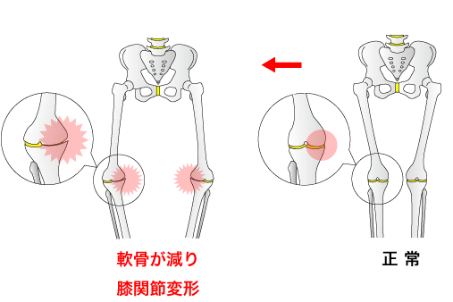 膝の関節が削れて変形してくると、O脚になり変形してくることを説明した画像です。