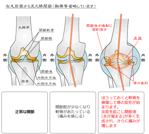 膝の軟骨が減った状態、そしてその段階を表した画像です