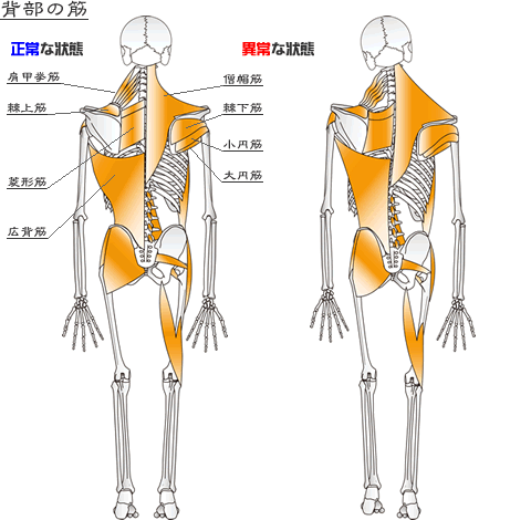 全身の骨格に付着した正常な状態と歪んだ状態の筋肉図筋肉図