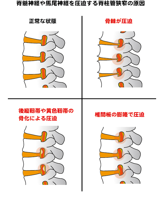脊柱管狭窄症の機序の説明をした画像