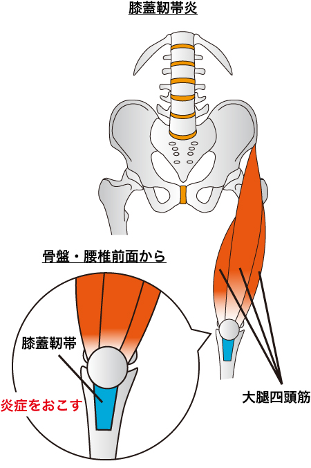 大腿四頭筋や腱の緊張を取り、付着部の負担を軽減することを説明した画像