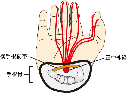 手根管症候群の原因を示した画像