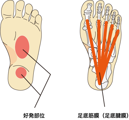 足底筋膜炎の好発部位を示す画像