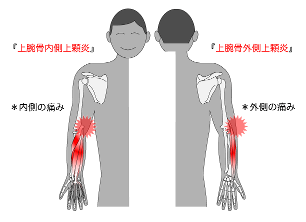 テニス肘で痛む部位を表した画像