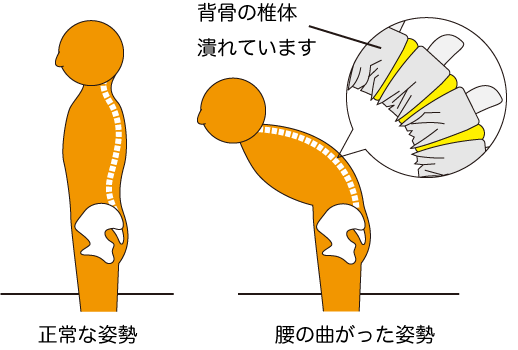 背骨の椎体圧迫骨折の画像