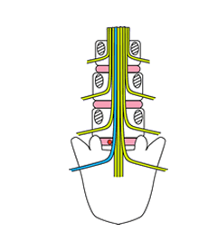 腰部椎間板外側ヘルニアの説明画像