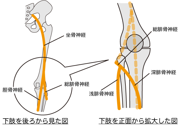 下垂足と脊柱管狭窄症の関係を表す