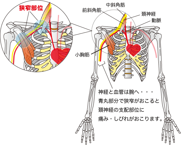 胸郭出口症候群の好発部位を表す画像
