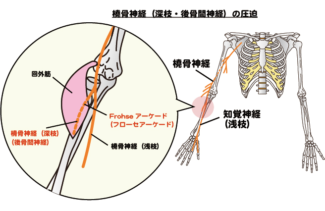 橈骨神経（深枝・後骨間神経）を表す画像