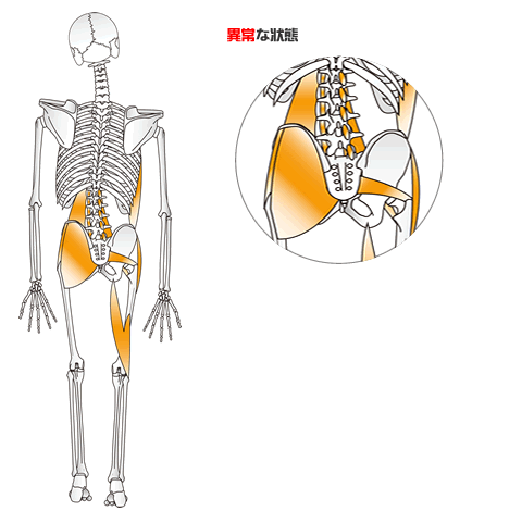 腰部のバランスの崩れた筋肉を説明した画像