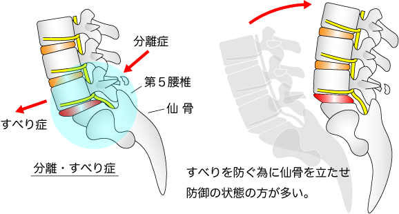 分離症・すべり症をを解説した画像